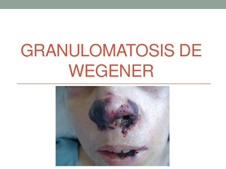 enfermedad de wegener